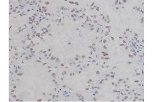 ABIN6267323 at 1/200 staining Human lung cancer tissue sections by IHC-P.
