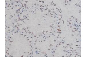 ABIN6267323 at 1/200 staining Human lung cancer tissue sections by IHC-P. (NPM1 anticorps  (pThr199))
