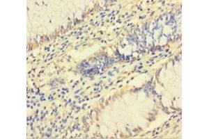 Immunohistochemistry of paraffin-embedded human colon cancer using ABIN7142784 at dilution of 1:100 (RPL26L1 anticorps  (AA 1-145))