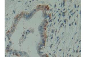 Detection of HMBS in Human Pancreas cancer Tissue using Polyclonal Antibody to Hydroxymethylbilane Synthase (HMBS)