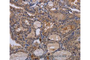 Immunohistochemistry of Human thyroid cancer using FADS1 Polyclonal Antibody at dilution of 1:60 (FADS1 anticorps)