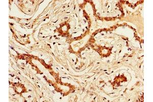 IHC image of ABIN7157190 diluted at 1:300 and staining in paraffin-embedded human breast cancer performed on a Leica BondTM system.