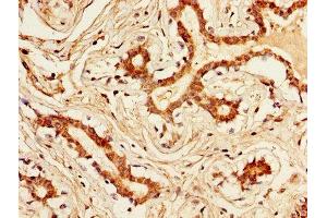 IHC image of ABIN7157190 diluted at 1:300 and staining in paraffin-embedded human breast cancer performed on a Leica BondTM system. (Kallikrein 1 anticorps  (AA 25-262))
