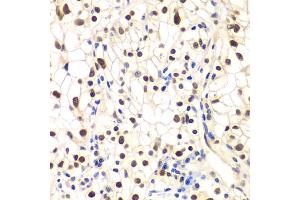 Immunohistochemistry of paraffin-embedded human kidney cancer using NFKBIB antibody (ABIN5973399) at dilution of 1/200 (40x lens). (NFKBIB anticorps)