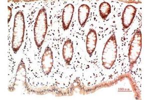 Immunohistochemical analysis of paraffin-embedded Human Colon Carcinoma Tissue using Collagen I Mouse mAb diluted at 1:200.