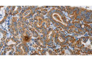 Immunohistochemistry of paraffin-embedded Human thyroid cancer using UPF1 Polyclonal Antibody at dilution of 1:35 (RENT1/UPF1 anticorps)