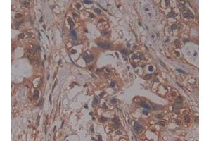 DAB staining on IHC-P; Samples: Human Pancreatic cancer Tissue (PRCP anticorps  (AA 108-376))