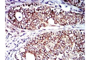 Immunohistochemical analysis of paraffin-embedded cervical cancer tissues using CD129 mouse mAb with DAB staining.