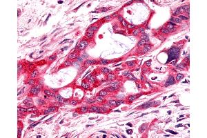 Anti-FZD9 / Frizzled 9 antibody IHC of human Pancreas, Carcinoma.