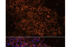 Immunofluorescence analysis of Human kidney cancer using SCNN1G Polyclonal Antibody at dilution of 1:100. (SCNN1G anticorps)