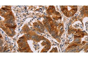 Immunohistochemistry of paraffin-embedded Human gastic cancer using ALDH3A1 Polyclonal Antibody at dilution of 1:55 (ALDH3A1 anticorps)