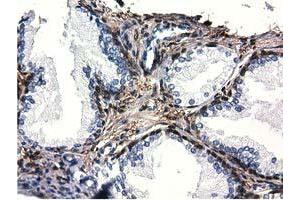 Immunohistochemical staining of paraffin-embedded Adenocarcinoma of Human ovary tissue using anti-QPRT mouse monoclonal antibody. (QPRT anticorps)