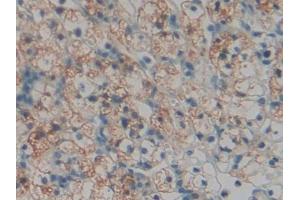 DAB staining on IHC-P; Samples: Human Renal cancer Tissue (TOR1AIP2 anticorps  (AA 249-476))