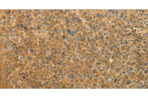 Immunohistochemistry of paraffin-embedded Human liver cancer tissue using RAB35 Polyclonal Antibody at dilution 1:50 (RAB35 anticorps)
