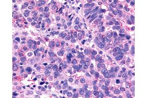 Anti-MRGX1 / MRGPRX1 antibody IHC of human Ovary, Carcinoma. (MRGPRX1 anticorps  (N-Term))