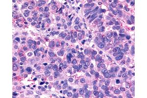Anti-MRGX1 / MRGPRX1 antibody IHC of human Ovary, Carcinoma.