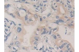Detection of CPB1 in Human Bile duct cancer Tissue using Polyclonal Antibody to Carboxypeptidase B1, Tissue (CPB1) (CPB1 anticorps  (AA 111-417))