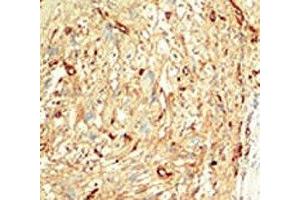 IHC analysis of FFPE human breast carcinoma tissue stained with the MST1 antibody