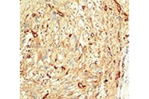 IHC analysis of FFPE human breast carcinoma tissue stained with the MST1 antibody (STK4 anticorps  (AA 385-415))