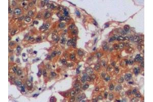 Detection of CA9 in Human Liver cancer Tissue using Polyclonal Antibody to Carbonic Anhydrase IX (CA9)