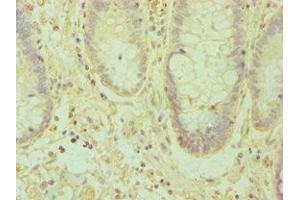 Immunohistochemistry of paraffin-embedded human colon cancer using ABIN7151874 at dilution of 1:100 (Ephrin A1 anticorps  (AA 19-182))