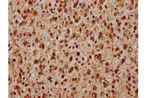 IHC image of ABIN7171666 diluted at 1:300 and staining in paraffin-embedded human glioma performed on a Leica BondTM system. (Tiparp anticorps  (AA 74-178))