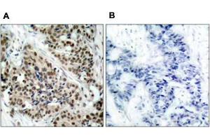 Immunohistochemical staining of paraffin-embbeded human breast carcinoma tissue using FOXO1 (phospho S256) polyclonal antibody  (A) or preincubated with blocking peptide (B).