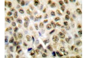Immunohistochemistry analyzes of Histone H1 antibody in paraffin-embedded human lung carcinoma tissue. (Histone H1 anticorps)