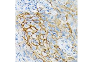 Immunohistochemistry of paraffin-embedded human lung cancer using GRIK2 Rabbit mAb (ABIN7267415) at dilution of 1:100 (40x lens). (GRIK2 anticorps)
