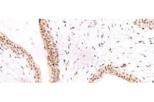 Immunohistochemistry of paraffin-embedded Human breast cancer tissue using CBFA2T2 Polyclonal Antibody at dilution of 1:60(x200) (CBFA2T2 anticorps)