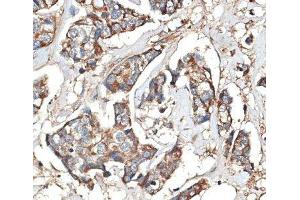 Immunohistochemistry of paraffin-embedded Human mammary cancer using KRT81 Polyclonal Antibody at dilution of 1:100 (40x lens). (KRT81 anticorps)