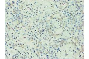 Immunohistochemistry of paraffin-embedded human breast cancer using ABIN7144436 at dilution of 1:100 (APOL1 anticorps  (AA 179-398))