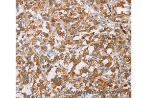 Immunohistochemistry of Human liver cancer using BDH1 Polyclonal Antibody at dilution of 1:60 (BDH1 anticorps)