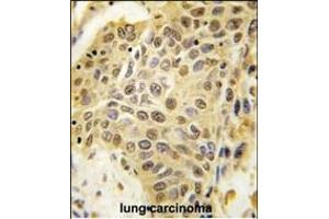 Formalin-fixed and paraffin-embedded human lung carcinoma tissue reacted with SENP5 Antibody (C-term) (ABIN388050 and ABIN2845616) , which was peroxidase-conjugated to the secondary antibody, followed by DAB staining. (SENP5 anticorps  (C-Term))
