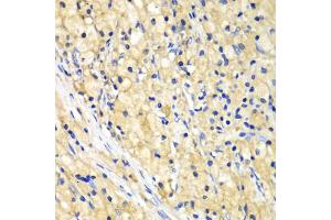 Immunohistochemistry of paraffin-embedded human lung cancer using NUP62 antibody (ABIN5971334) at dilution of 1/100 (40x lens). (NUP62 anticorps)