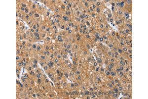 Immunohistochemistry of Human thyroid cancer using CEACAM3 Polyclonal Antibody at dilution of 1:70 (CEACAM3 anticorps)