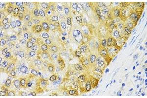 Immunohistochemistry of paraffin-embedded Human liver cancer using PA2G4 Polyclonal Antibody at dilution of 1:100 (40x lens). (PA2G4 anticorps)