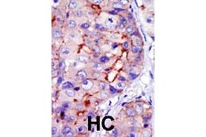 Formalin-fixed and paraffin-embedded human hepatocellular carcinoma tissue reacted with CAMK1D polyclonal antibody  , which was peroxidase-conjugated to the secondary antibody, followed by DAB staining. (CAMK1D anticorps  (C-Term))