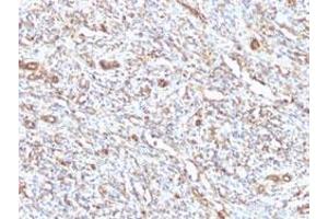 Immunohistochemical staining (Formalin-fixed paraffin-embedded sections) of human rhabdomyosarcoma with VIM monoclonal antibody, clone VM1170 . (Vimentin anticorps)