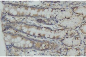 ABIN6274989 at 1/100 staining human colon carcinoma tissue sections by IHC-P.