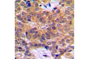 Immunohistochemical analysis of RCBTB1 staining in human breast cancer formalin fixed paraffin embedded tissue section.