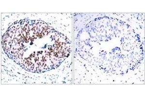 Immunohistochemistry analysis of paraffin-embedded human breast carcinoma, using STAT5A (Phospho-Ser780) Antibody.
