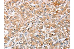 The image on the left is immunohistochemistry of paraffin-embedded Human thyroid cancer tissue using ABIN7131058(SIGLEC9 Antibody) at dilution 1/40, on the right is treated with fusion protein. (SIGLEC9 anticorps)