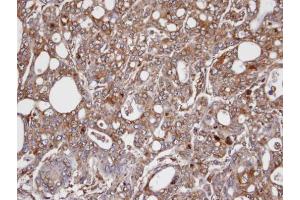 IHC-P Image Immunohistochemical analysis of paraffin-embedded NCI-N87 xenograft, using AKR1C3, antibody at 1:100 dilution.