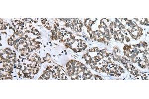 Immunohistochemistry of paraffin-embedded Human esophagus cancer tissue using CARTPT Polyclonal Antibody at dilution of 1:25(x200) (CARTPT anticorps)