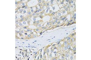 Immunohistochemistry of paraffin-embedded human breast cancer using SLC3A2 antibody.