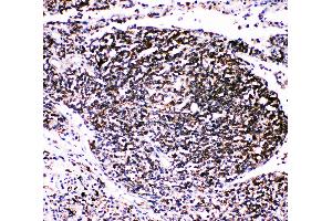 Anti-TRAF4 antibody, IHC(P) IHC(P): Human Lung Cancer Tissue (TRAF4 anticorps  (C-Term))