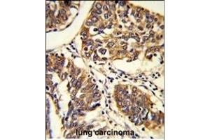 Formalin-fixed and raffin-embedded human lung carcinoma reacted with BPC1 Antibody (Center), which was peroxidase-conjugated to the secondary antibody, followed by DAB staining. (PABP anticorps  (AA 250-279))