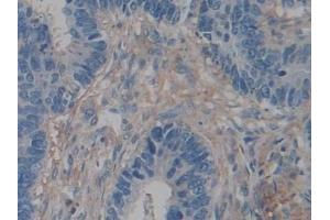 Detection of ACTg2 in Human Colorectal cancer Tissue using Polyclonal Antibody to Actin Gamma 2, Smooth Muscle (ACTg2)