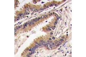 IHC analysis of FFPE human lung carcinoma tissue stained with ERK4 antibody (MAPK7 anticorps  (AA 527-557))